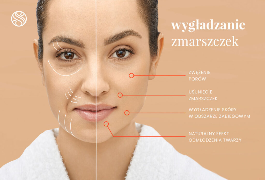 Źródło: https://satinell.pl/zmarszczki-mimiczne/